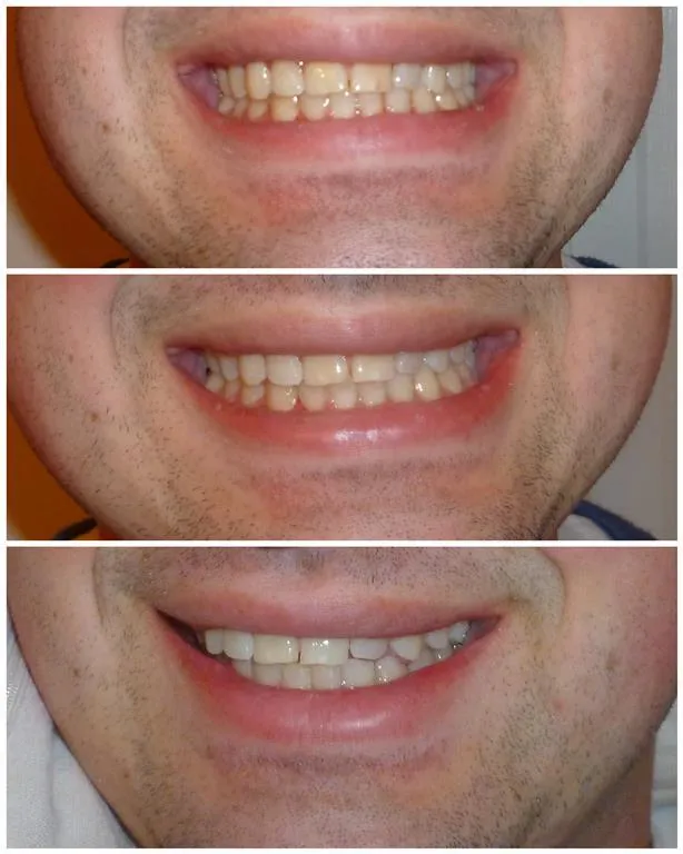 26485 tanda pearl teeth whitening image3