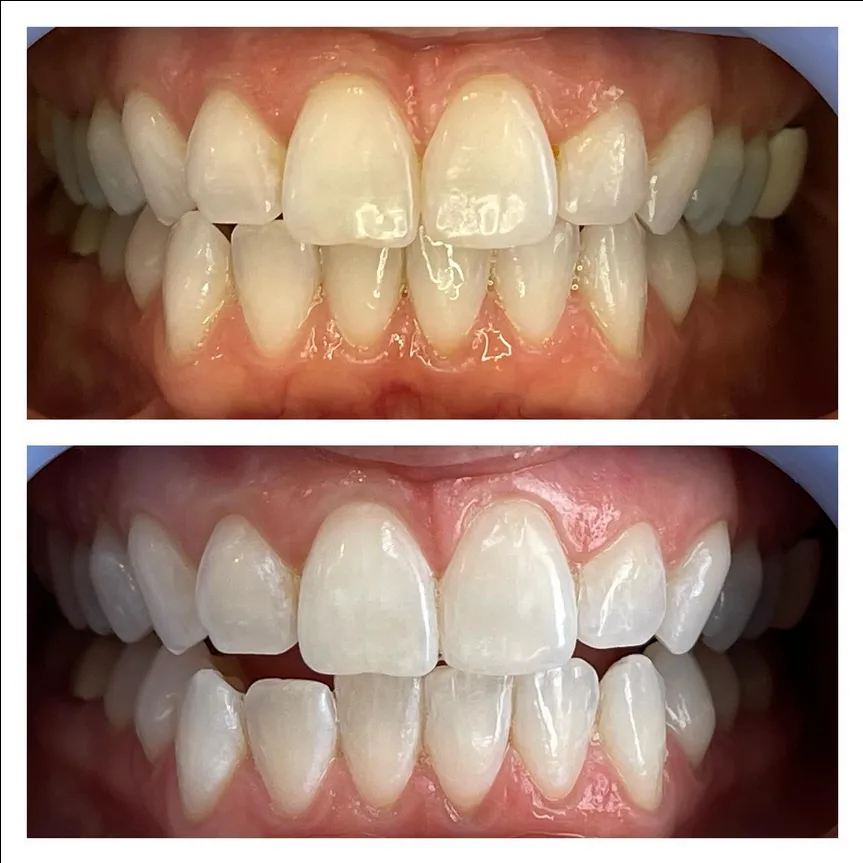 26487 take home whitening kit