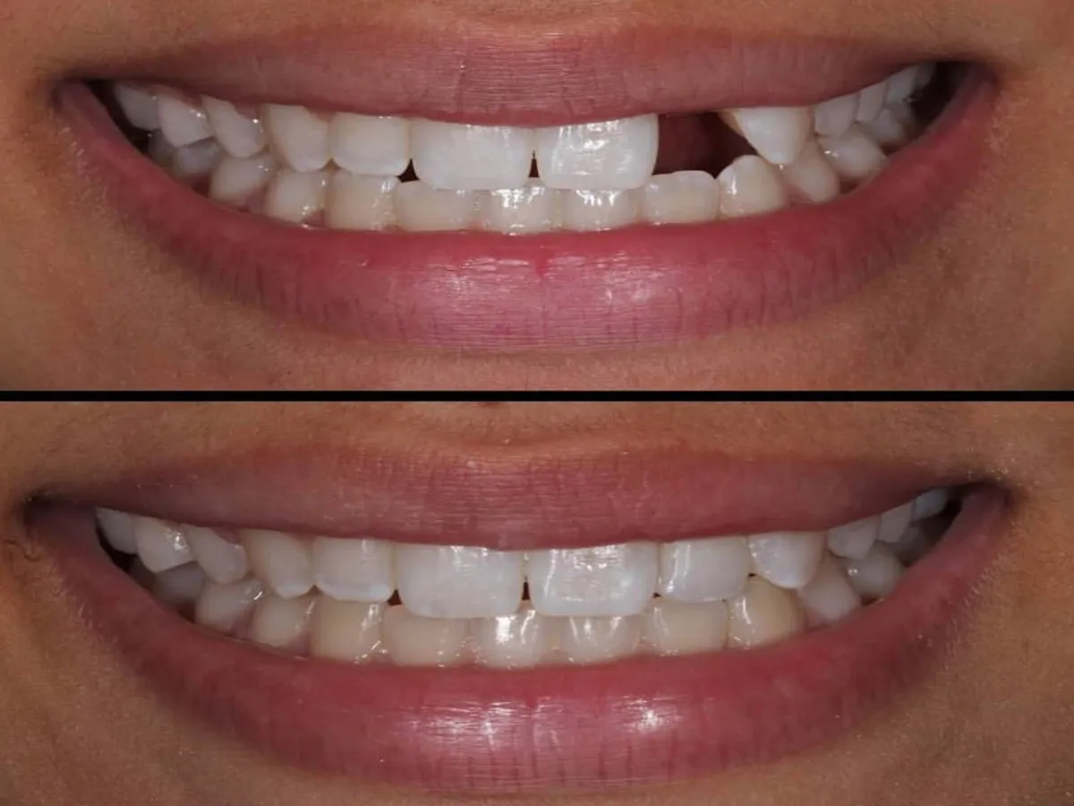 26488 in office teeth whitening