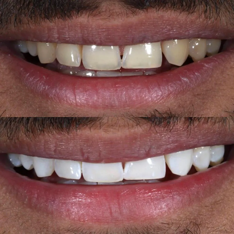 26490 teeth discoloration