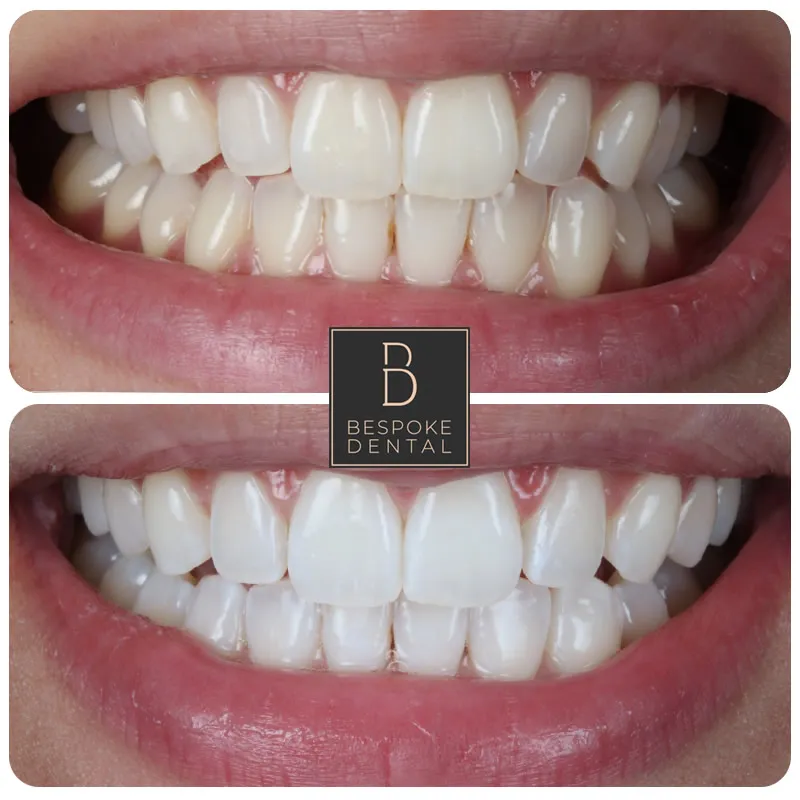 26490 teeth whitening dentist