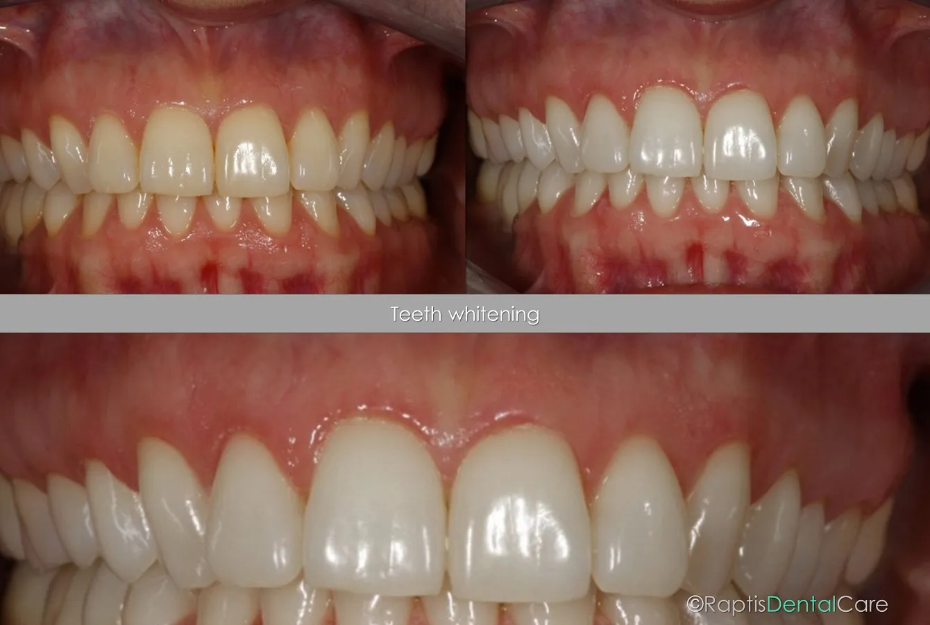 26491 teeth whitening wien image4