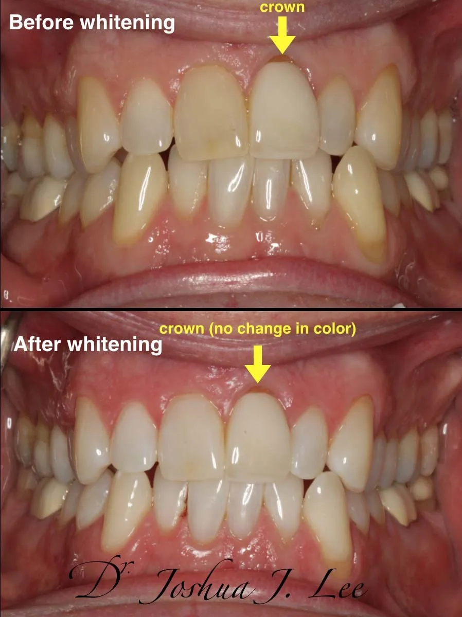 26492 zoom2 whitening overview