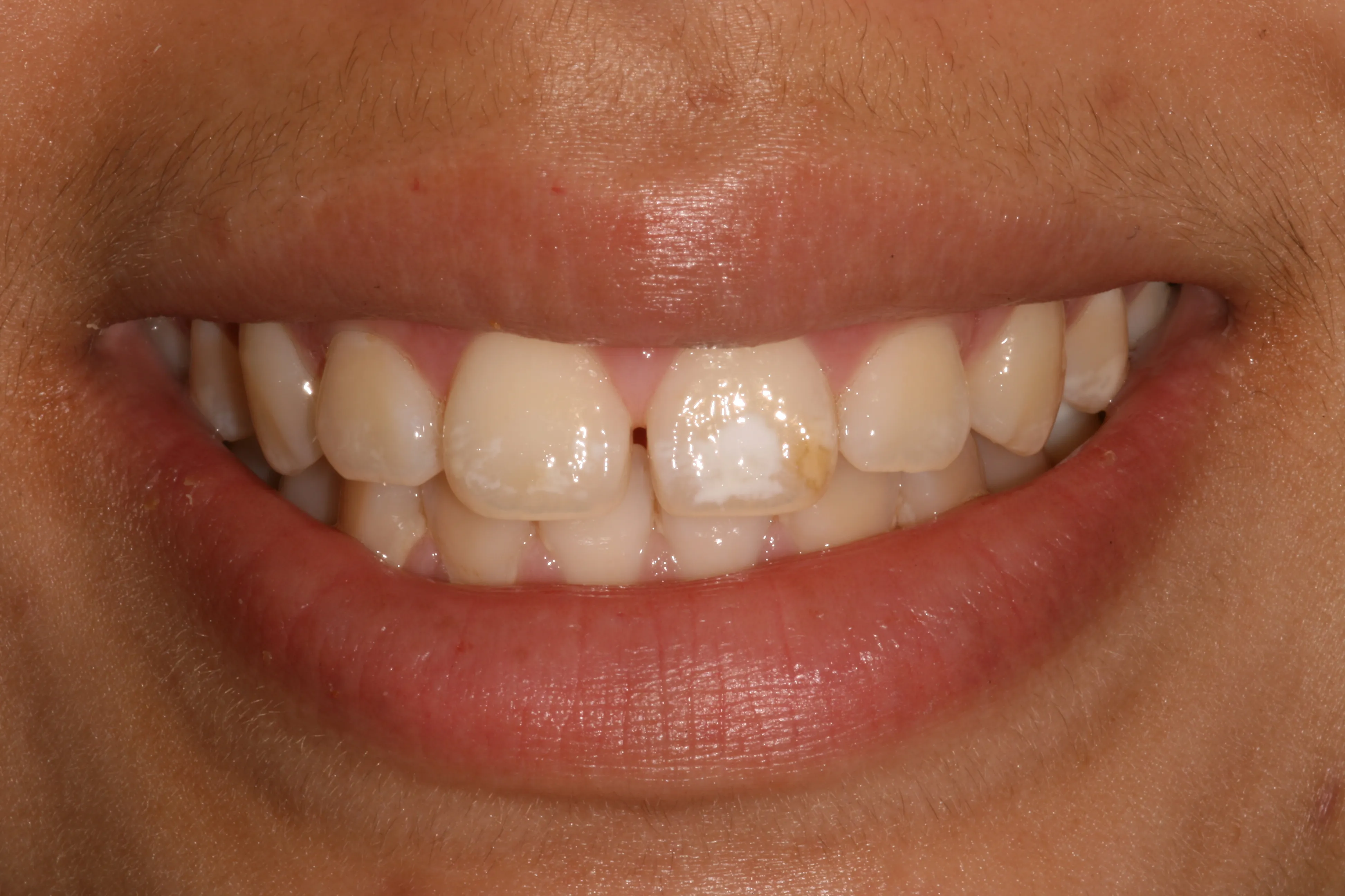 26495 teeth whitening white spots image3