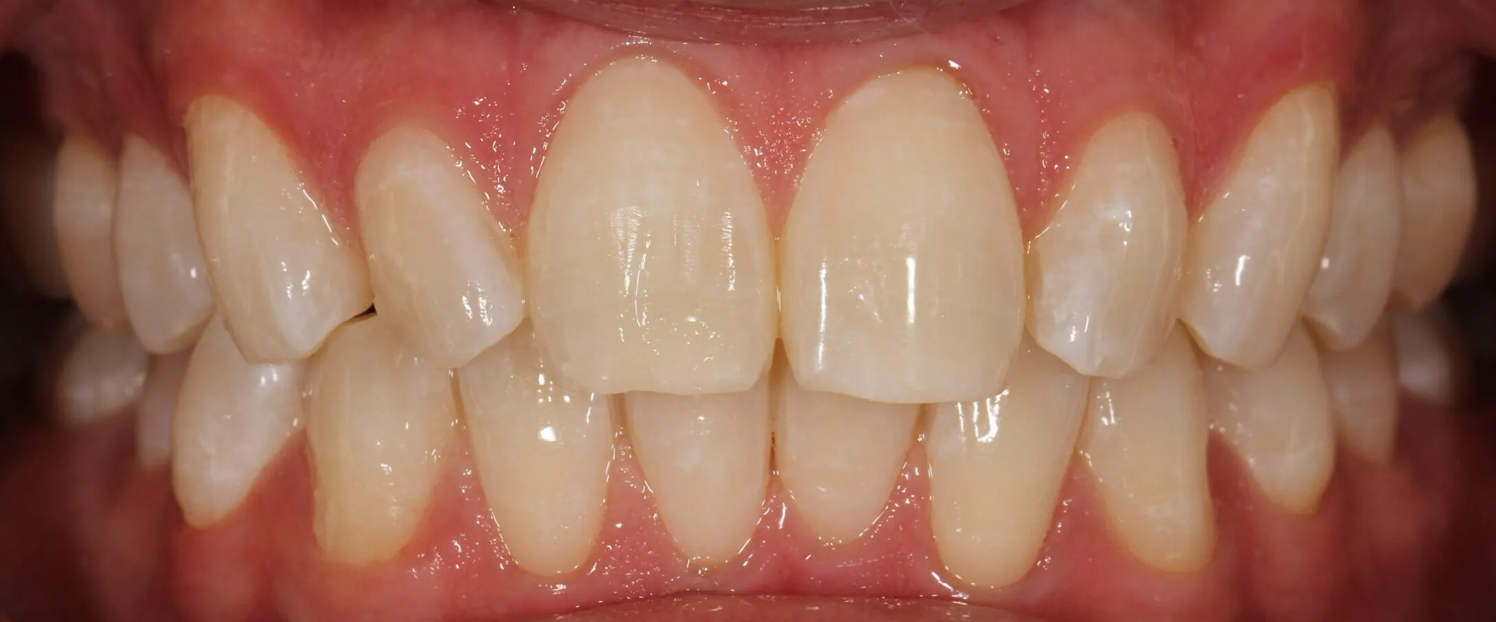 26495 teeth whitening white spots image5