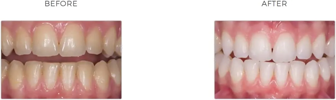 26497 novon teeth whitening oral hygiene