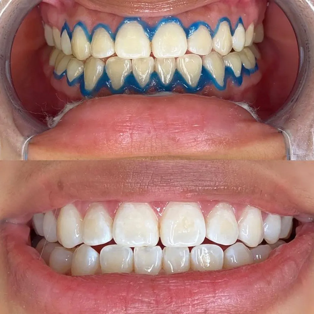 26501 in office vs home whitening