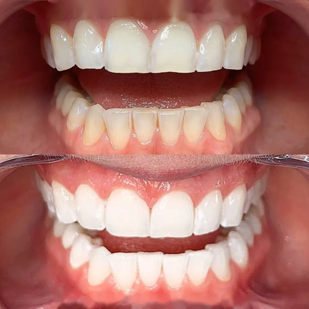 26501 teeth whitening methods