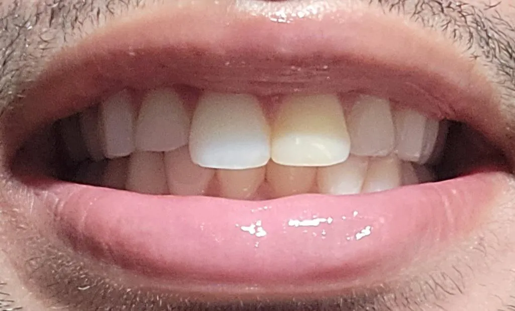 26504 carbamide peroxide whitening