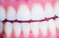 26508 claremont teeth whitening before after