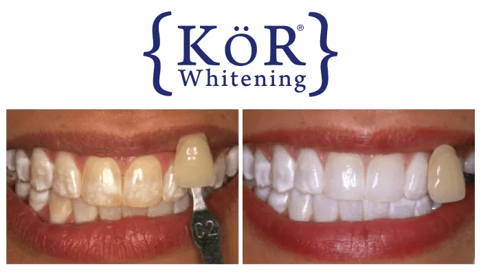 26509 at home teeth whitening