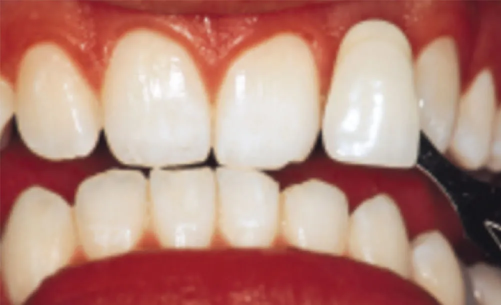 26517 teeth whitening results
