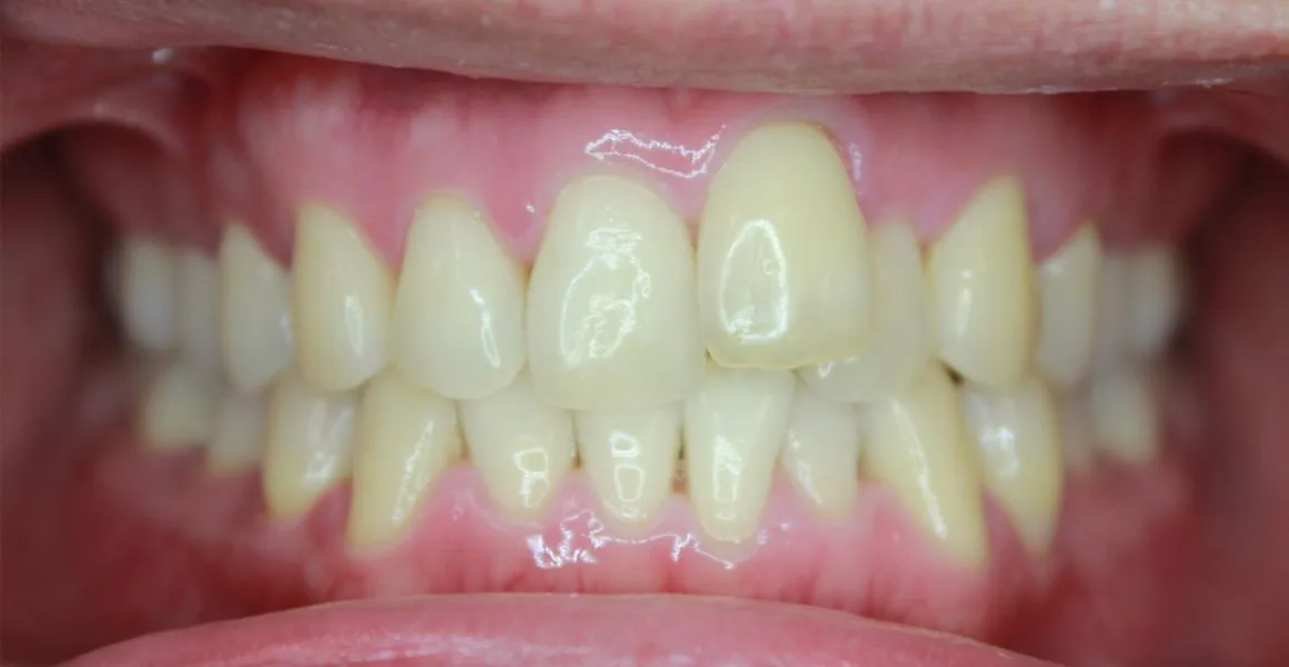 26521 red wine teeth