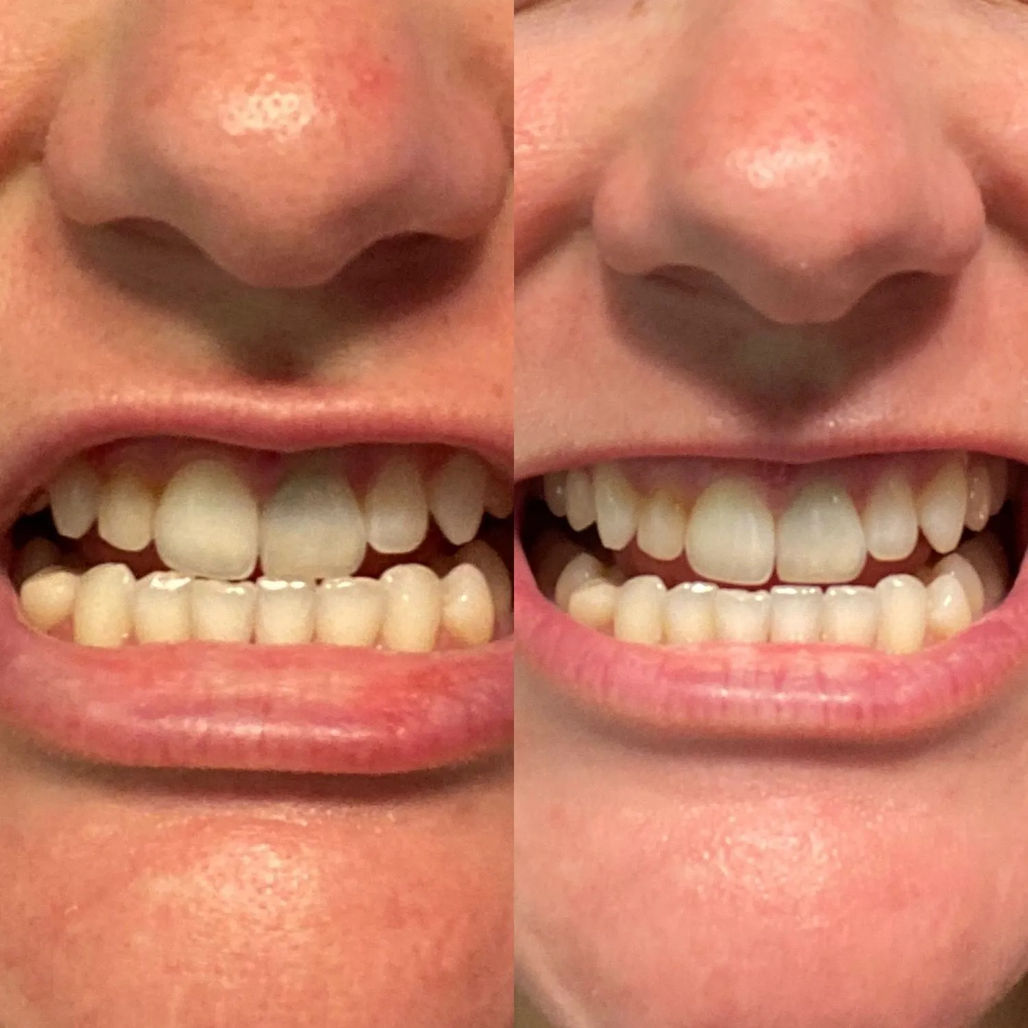 26528 alternative whitening