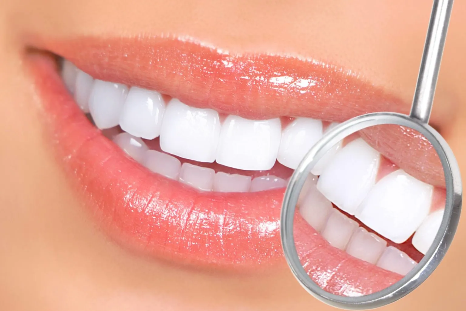 26530 whitening trays