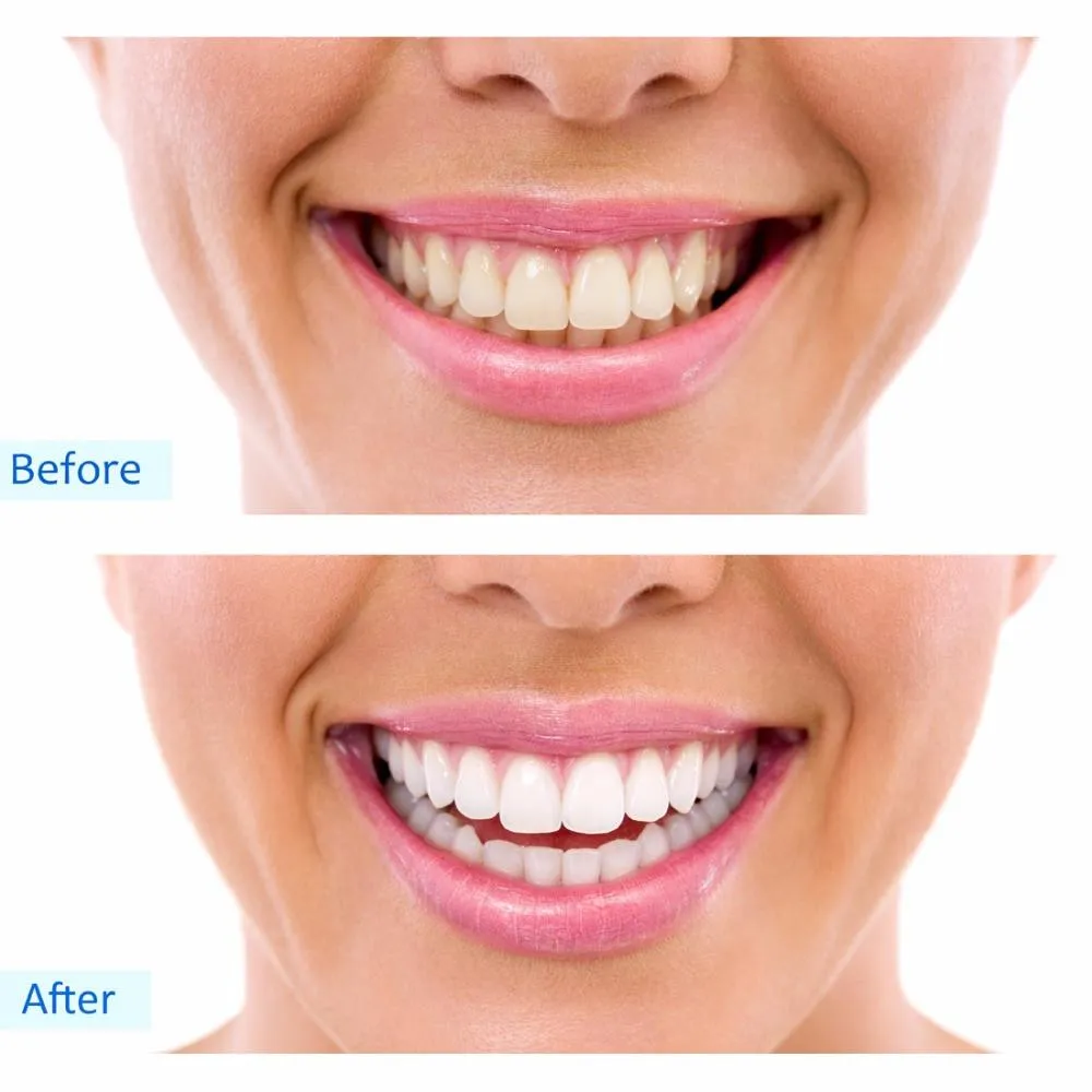 26545 teeth whitening paarl cost effective
