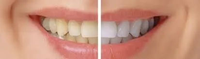 26557 in office teeth whitening