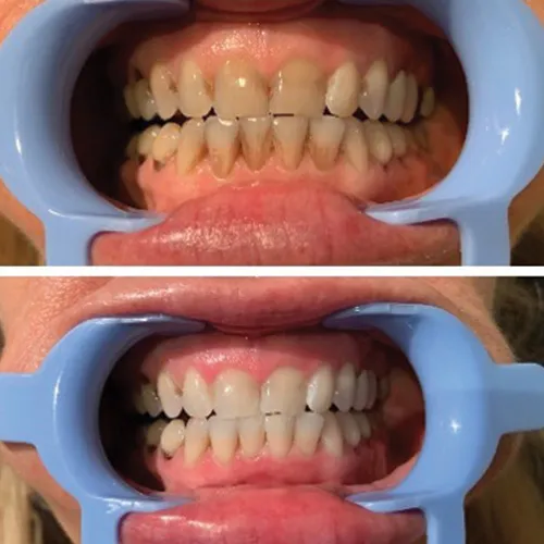 26561 oral hygiene routine