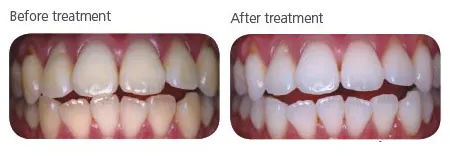 26567 pola office whitening patient smile