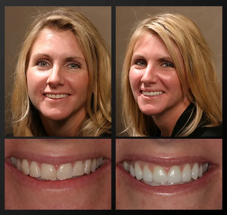 26568 in office teeth whitening
