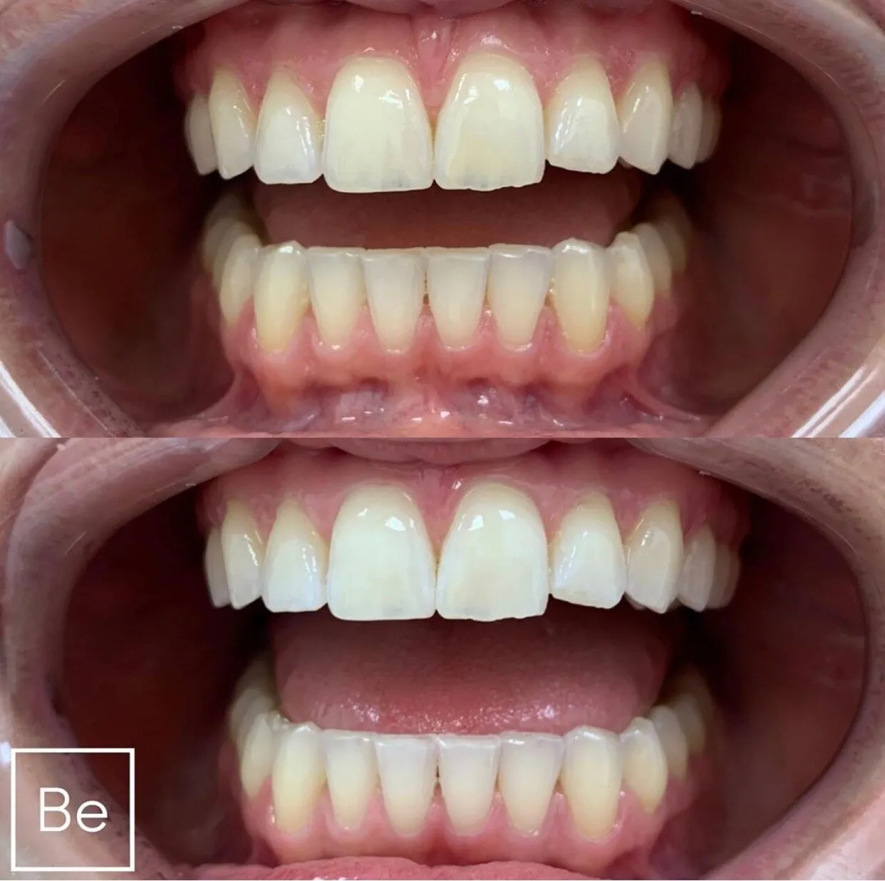 26568 teeth staining prevention