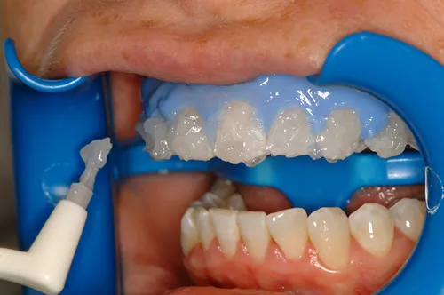 26588 at home whitening kits