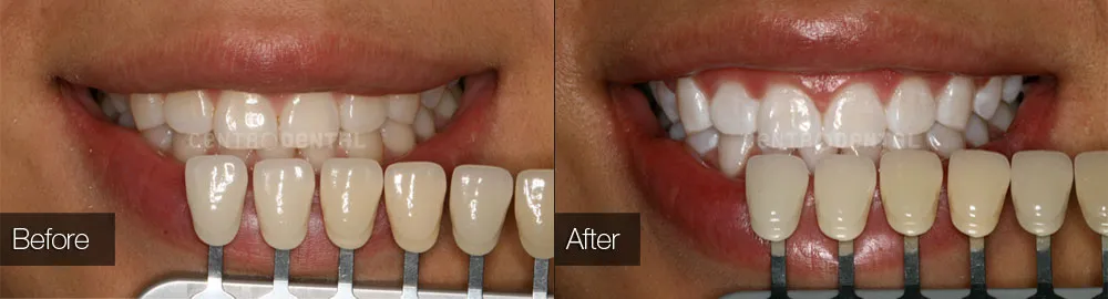 26600 alternative teeth whitening