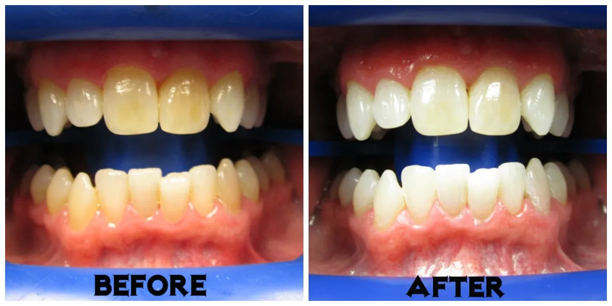 26600 zoom teeth whitening results