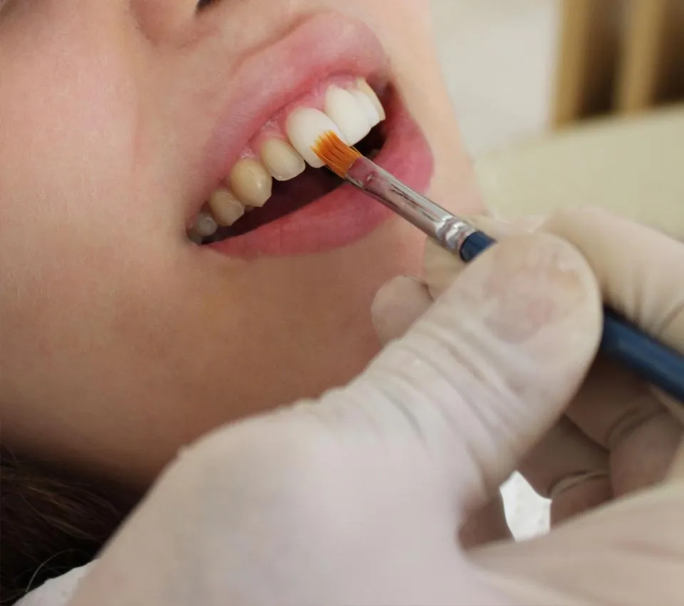 26602 veneers results