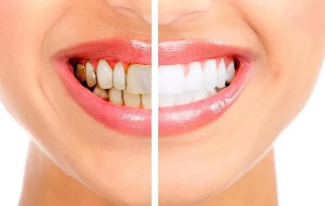 26603 in office teeth whitening