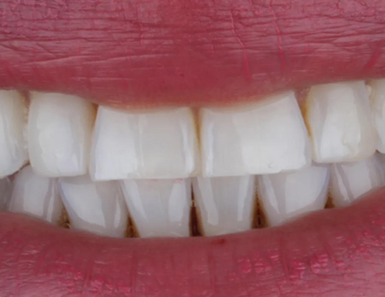 /img/26605-laser-teeth-whitening-limerick-aftercare.webp