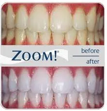 26606 teeth whitening burbank 1