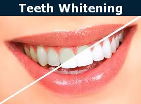 26606 teeth whitening burbank 2