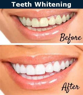 26606 teeth whitening burbank 4