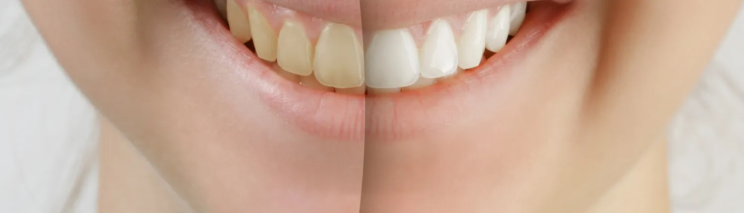 26606 teeth whitening burbank 6