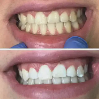 /img/26606-teeth-whitening-burbank-7.webp