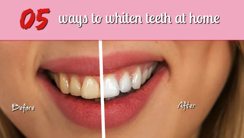 26614 teeth whitening ingredients