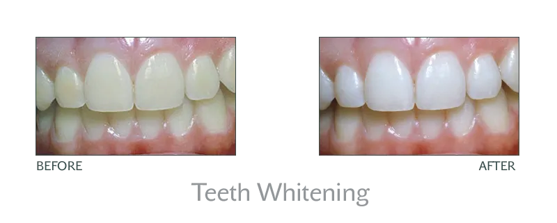 26617 teeth whitening valencia ca at home kits