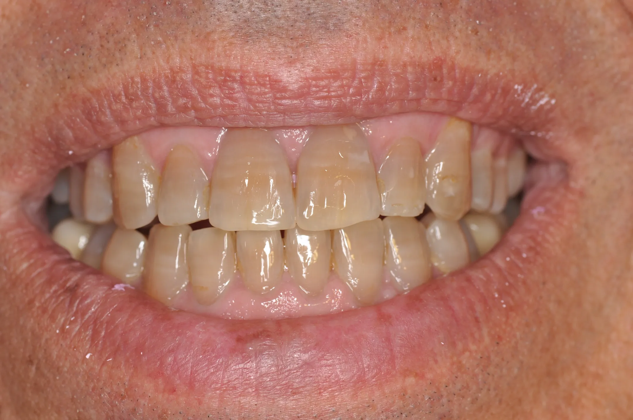 26617 teeth whitening valencia ca professional