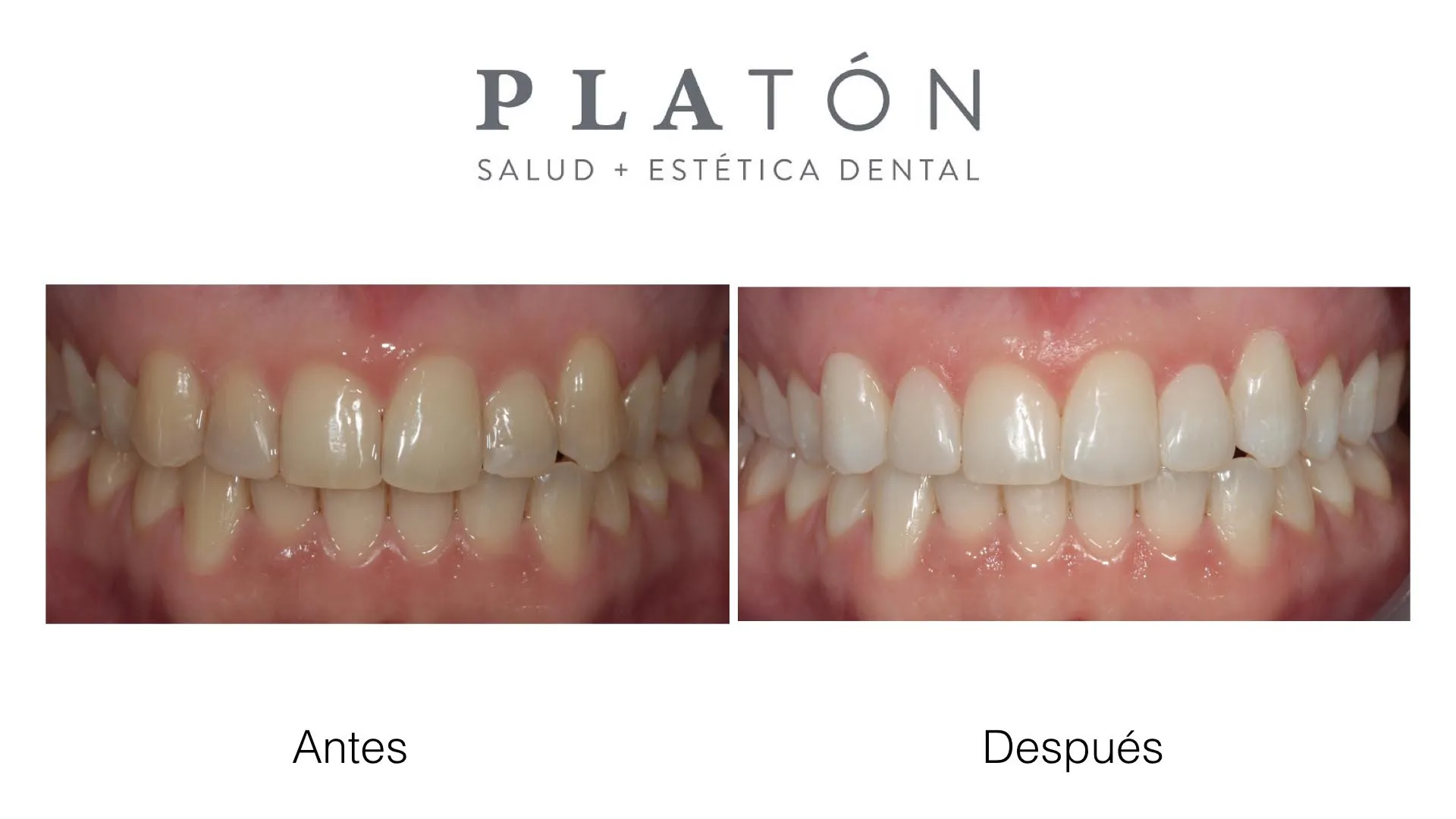 26618 teeth whitening process spain