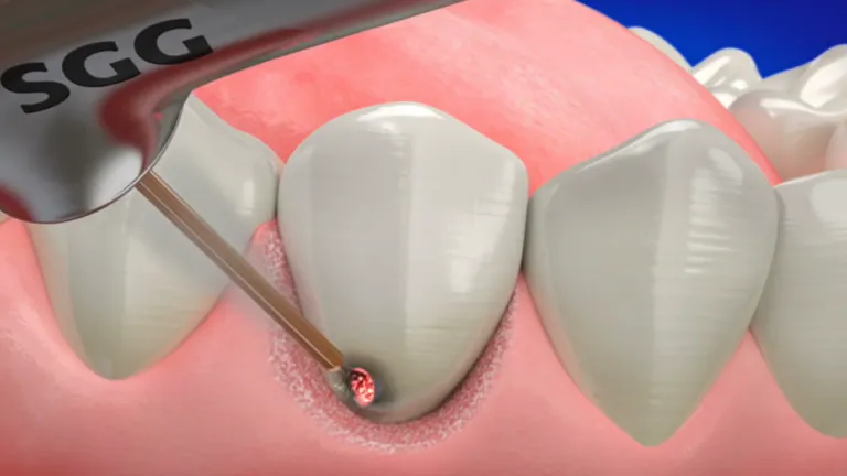 26624 biolase laser whitening safety