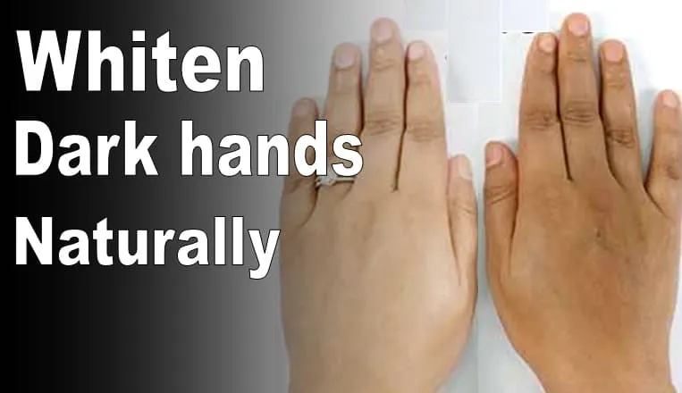 26626 hands exfoliation