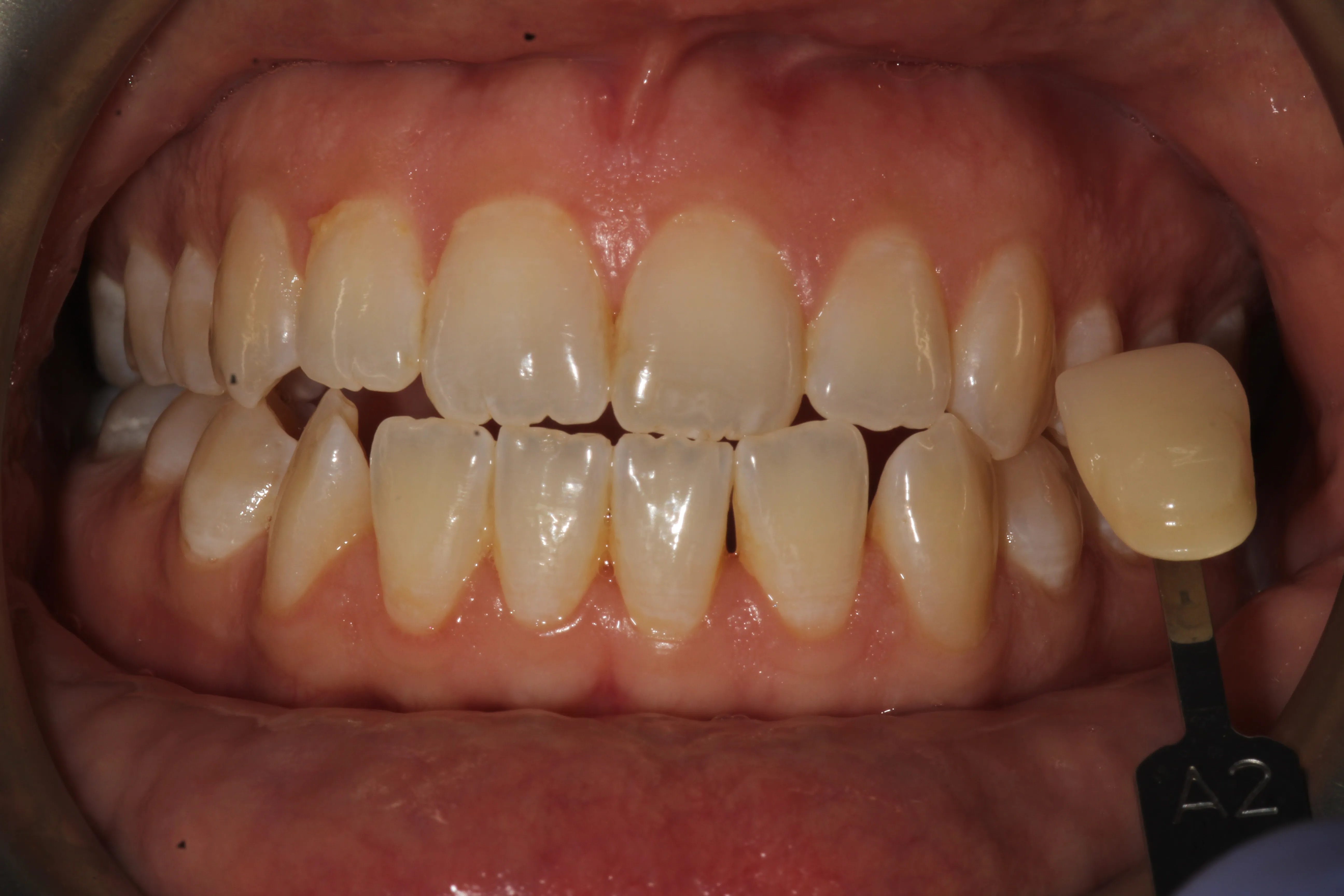 26637 teeth whitening before after