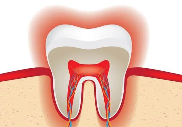 26645 teeth whitening sensitivity 2