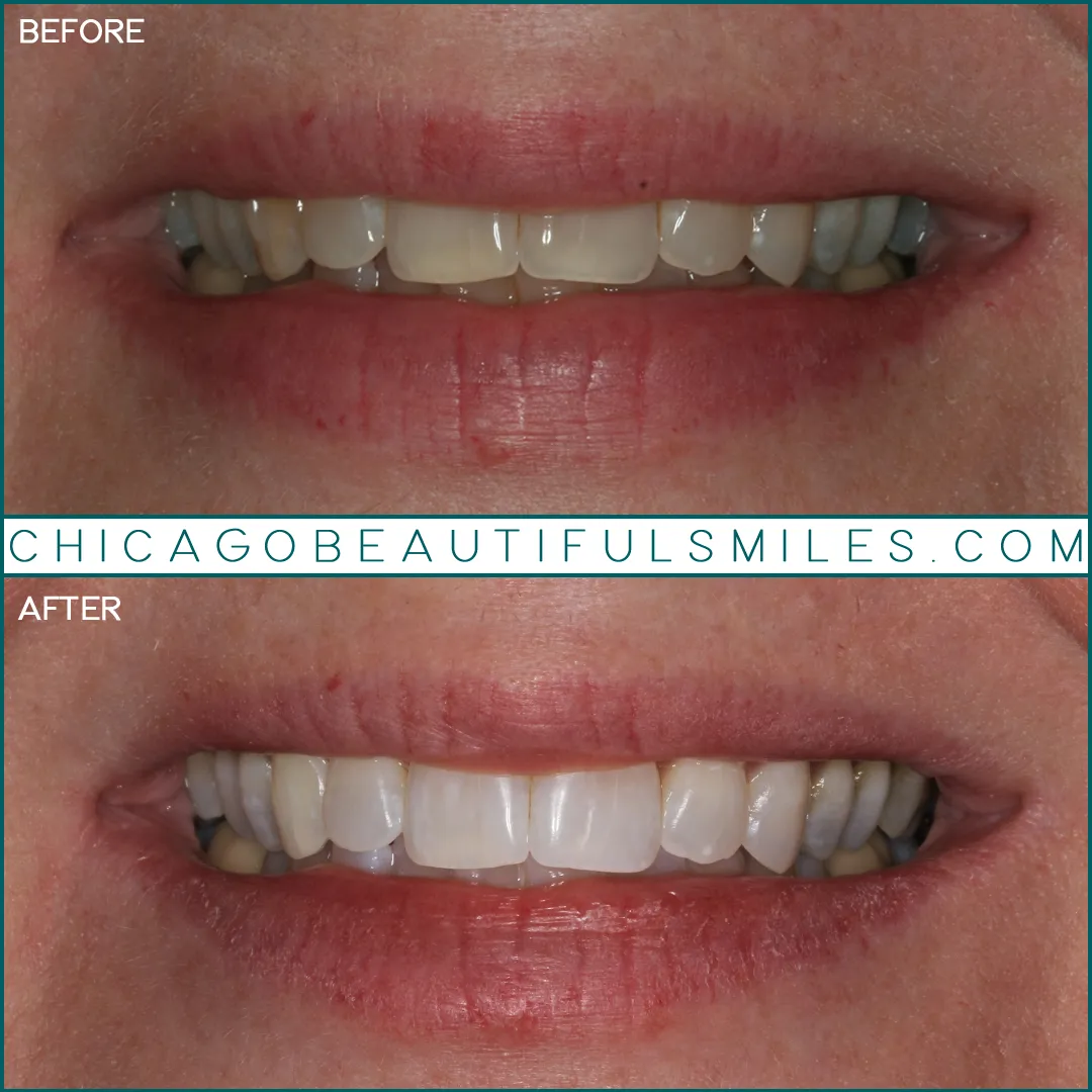 26646 uneven teeth whitening