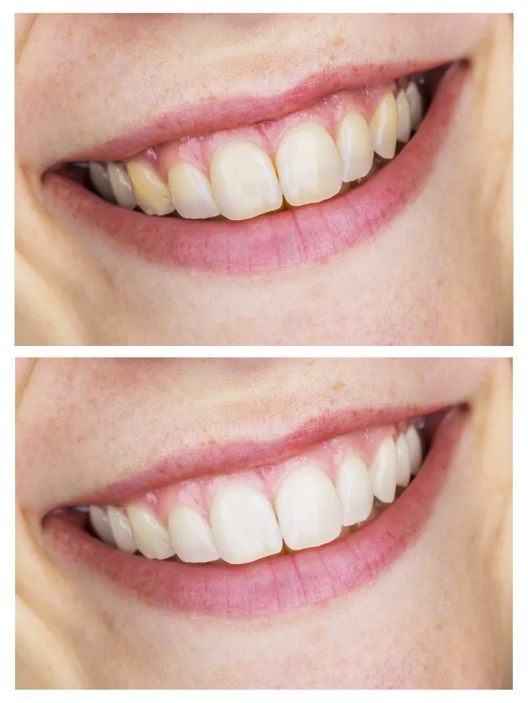 26647 teeth whitening maintenance