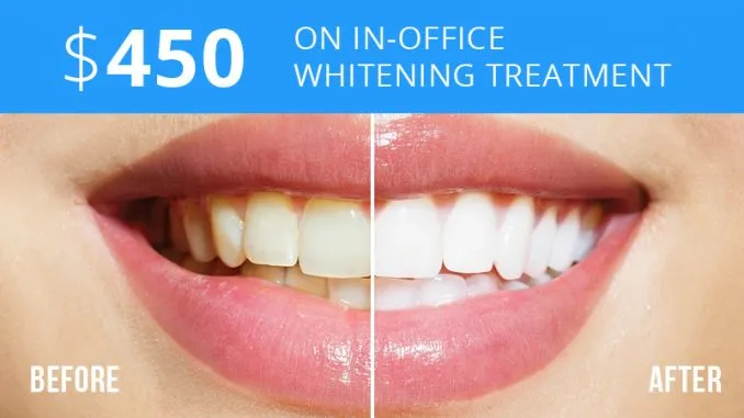 26651 at home whitening kits