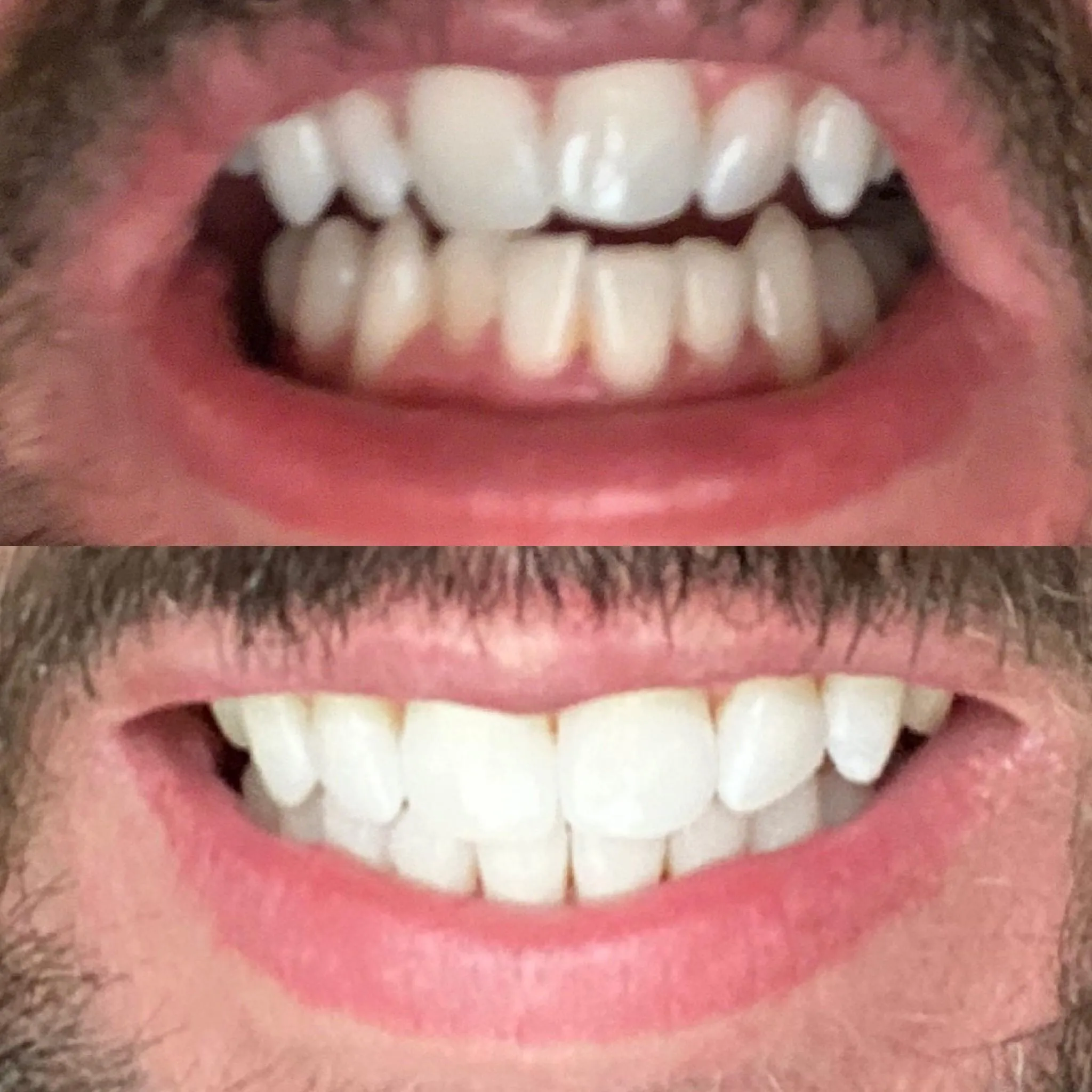 26652 teeth whitening process
