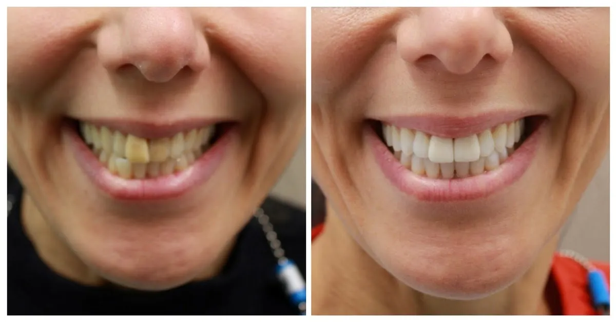 26656 affordable teeth whitening