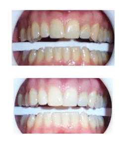 26658 laser teeth whitening austin before after